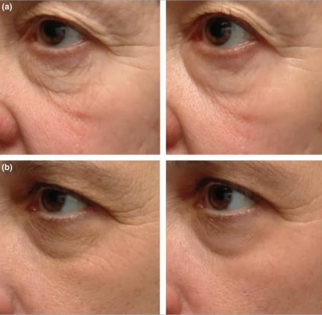 Retinol lek na co? Odkryj jego skutki i zastosowania w terapii skóry
