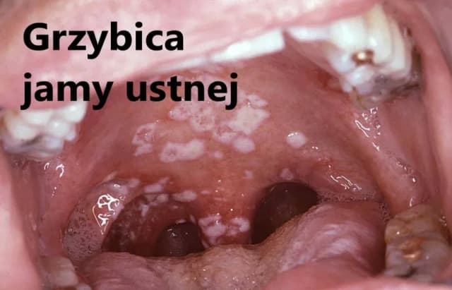 Skuteczne leki na grzybicę jamy ustnej - uniknij bólu i dyskomfortu